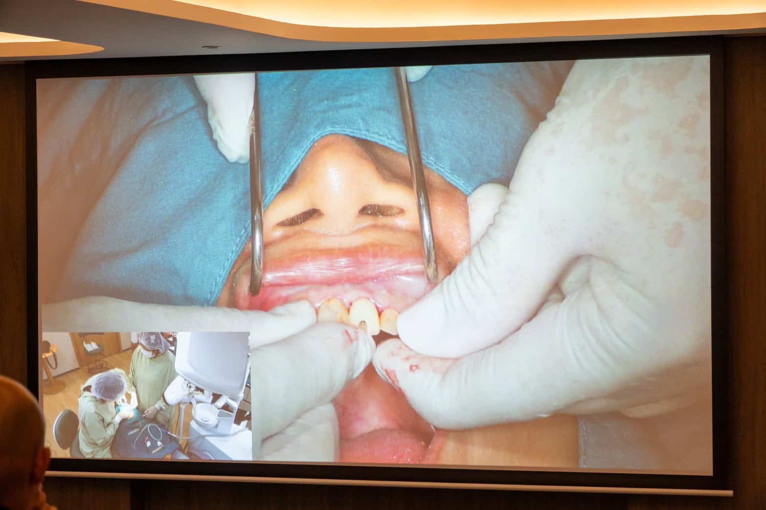ภาพบรรยากาศจากหลักสูตรอบรม“Guided Immediacy: Esthetic Zone and Posterior!” 60 LINE ALBUM 22668 250622 23